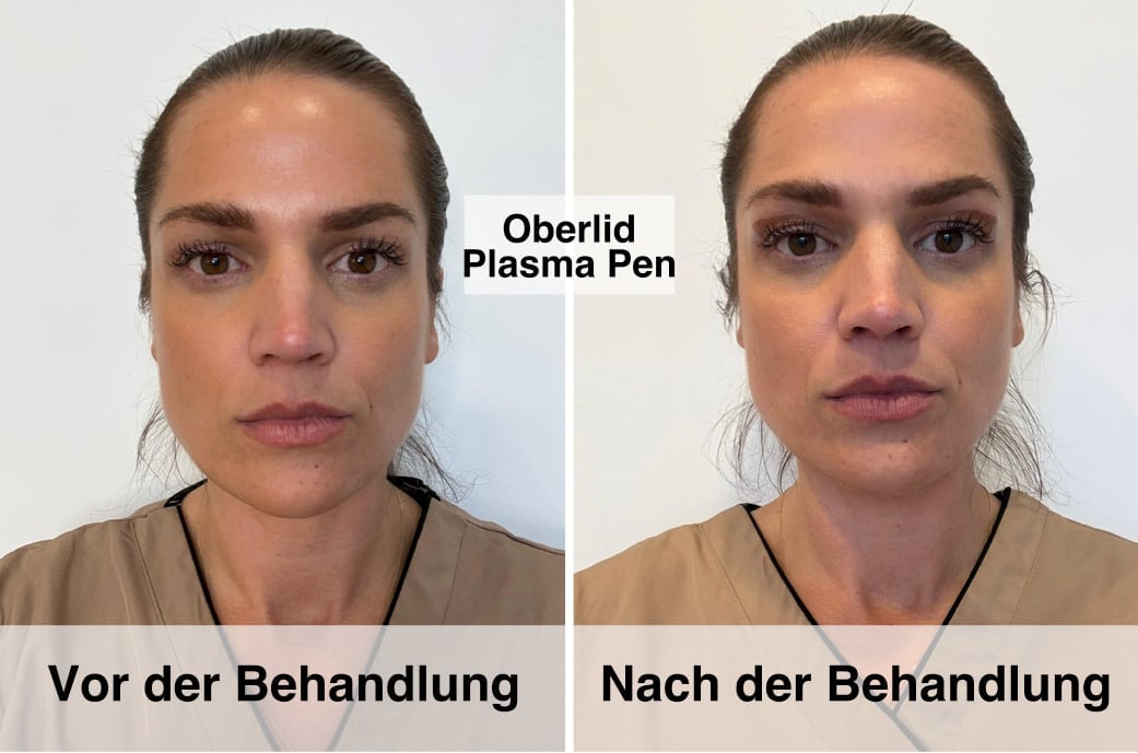 Vorher-Nachher Ergebnis einer Oberlid Plasma Pen Behandlung - Straffung der hängenden Augenlider ohne Operation