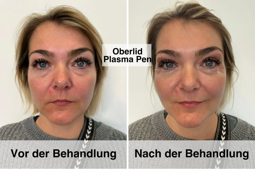 Vorher-Nachher Ergebnis einer Plasma Pen Oberlid Behandlung - Reduzierte Schwellungen und verbesserte Hautstruktur