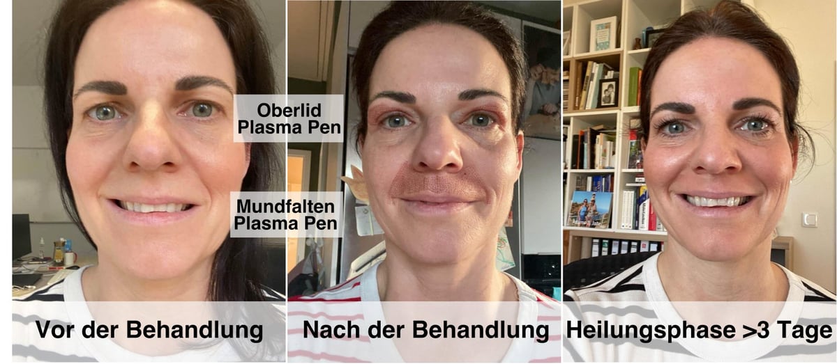 Dreistufiger Vorher-Nachher Vergleich einer Plasma Pen Oberlid Behandlung - Vor dem Eingriff, direkt nach der Behandlung und in der Heilungsphase nach 3+ Tagen